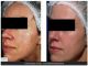 Rejuvenecimiento facial – elimina manchas con laser ipl malaga