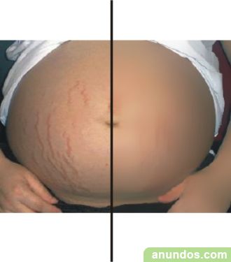 precio de tratamiento laser para estrias precio de tratamiento laser para estrias