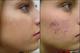 Depilacion laser vello facial. depilación laser permanente. vello