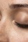 Micropigmentación de pecas y lunares